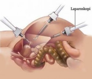 Laparoskopik-cerrahi2